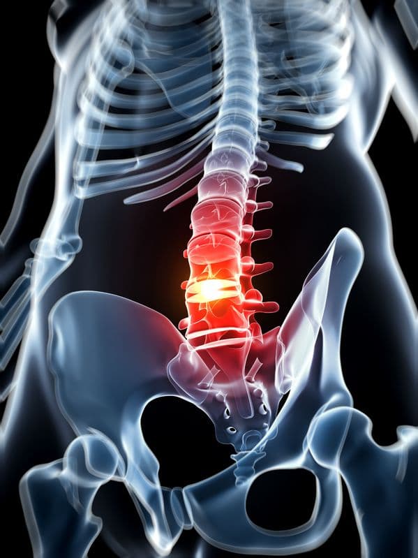 Medical illustration of herniated lumbar disc glowing at lower spine — sciatica treatment Forest Hills Queens NY