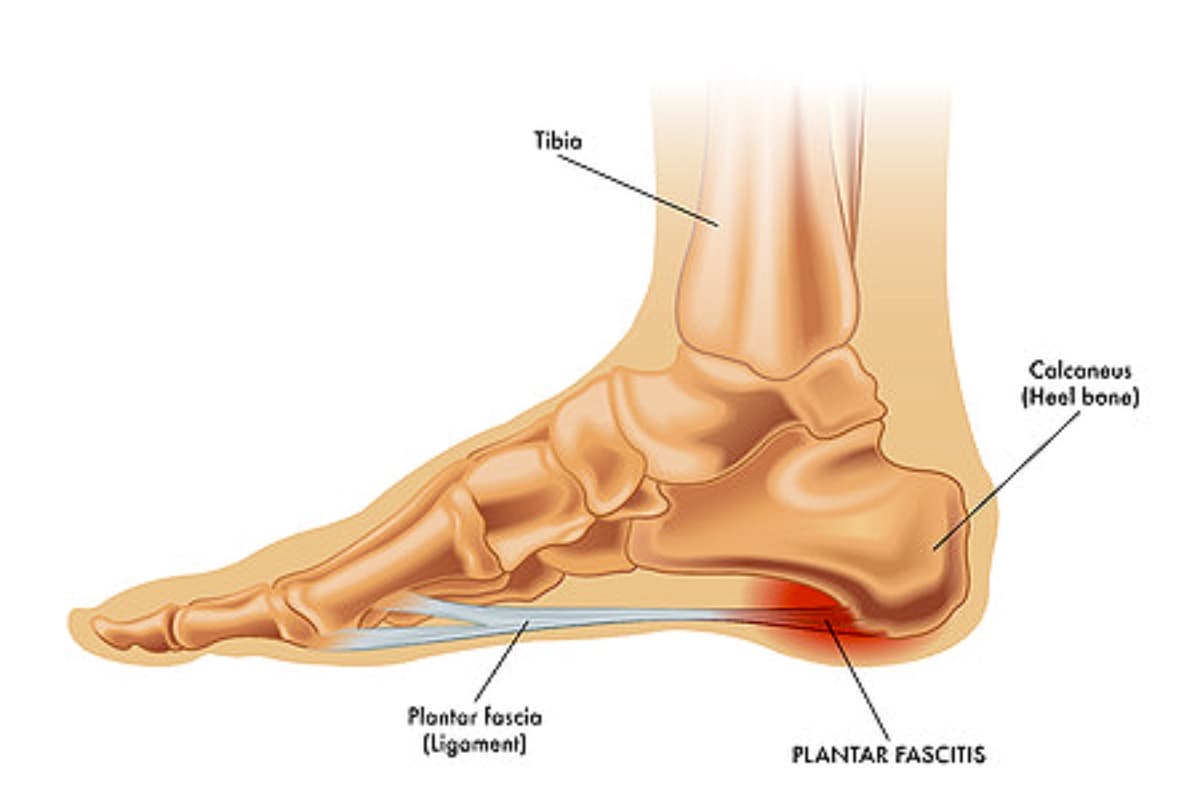Medical illustration of plantar fasciitis heel and arch pain — treatment in Forest Hills Queens NY